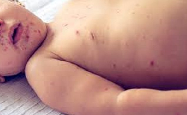 Measles Claims Lives of Five Children in Tando Allahyar